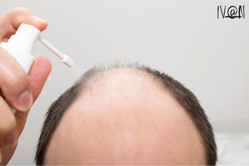scalp spray for dandruff